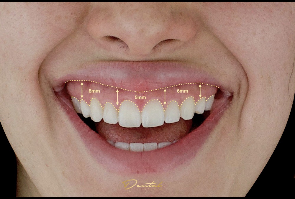 Sonrisa Gingival