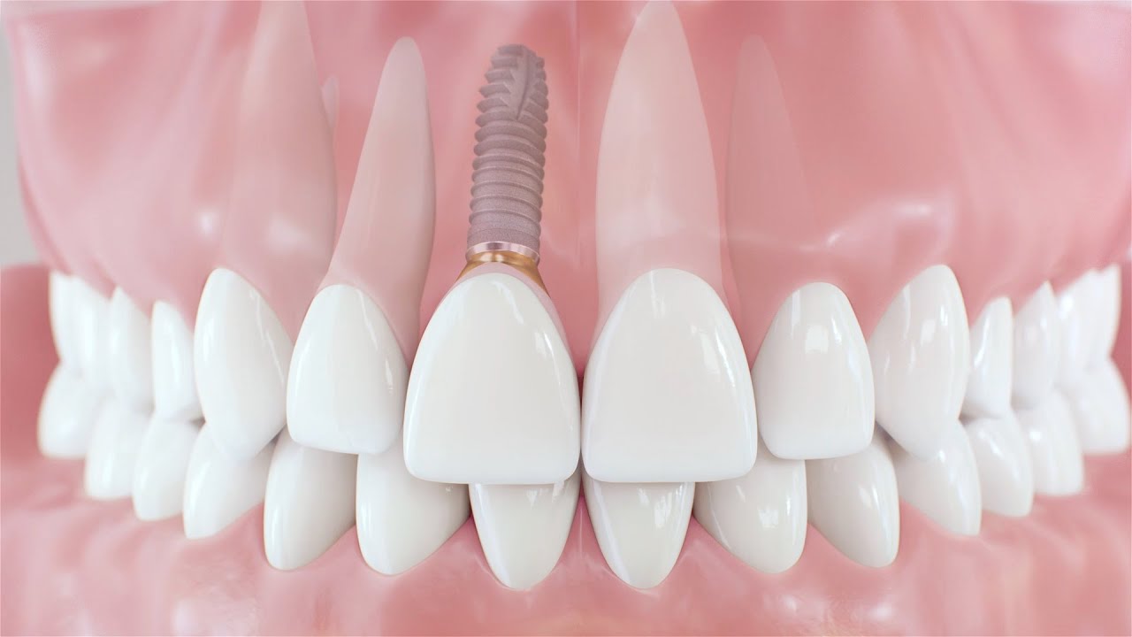 Implantes Dentales